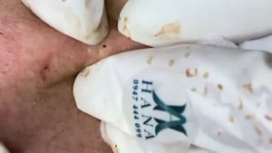 Relaxing Acne Treatment Acnes Treatment  95