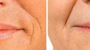 Как убрать морщины на лице