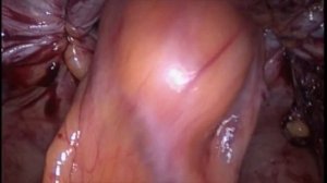 Laparoscopic parastomal hernia repair