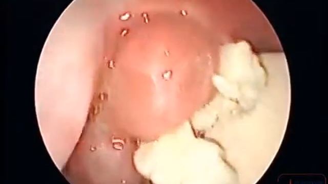 Казеозные массы в лакунах миндалин.mp4 смотреть онлайн