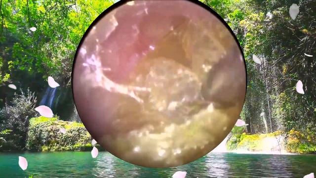 ВЫЛУЩИВАНИЕ УШНОЙ СЕРЫ Медицинская часть-УШНАЯ ПРОБКА | УШНЫЕ БОЛЕЗНИ | ИНОРОДНОЕ ТЕЛО В В УШНОМ ПР смотреть онлайн