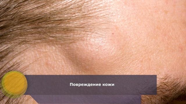 Жировики на теле, на лице: причины | Как избавиться от жировика (липомы) смотреть онлайн