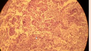 Плоскоклеточный неороговевающий рак кожи