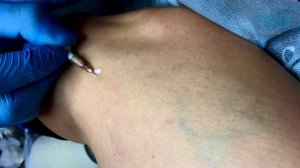 АРД-КЛИНИК. Склеротерапия.mp4