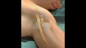 Идентификация кожно-мышечного нерва при блокаде плечевого сплетения