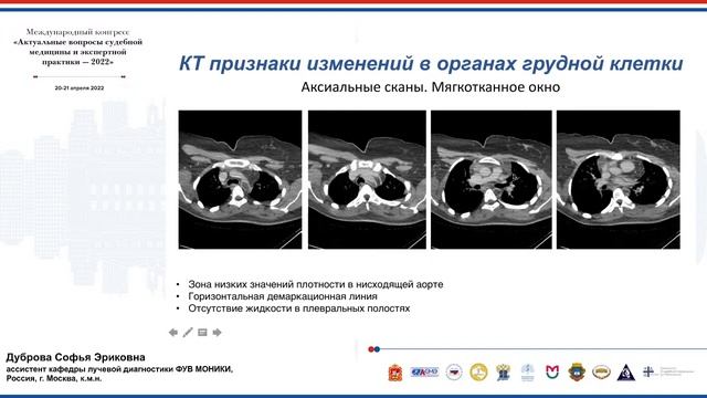 ПОСМЕРТНАЯ КОМПЬЮТЕРНАЯ ТОМОГРАФИЯ ПРИ НАХОЖДЕНИИ ТРУПА В УСЛОВИЯХ НИЗКОЙ ТЕМПЕРАТУРЫ/ДУБРОВА С.Э.