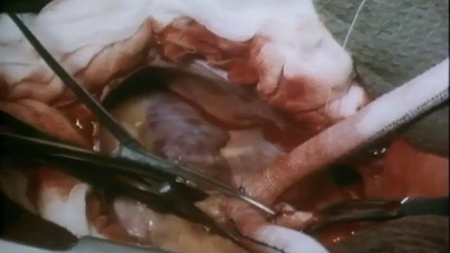 Неспецифический аортоартериит смотреть онлайн