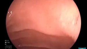 Upper Gastrointestinal Endoscopy: Examination Technique and Standard Findings