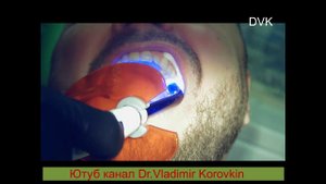 Фиксация циркониевой коронки 26 зуб.