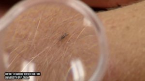 How to Remove Head Lice!  Live Removal, Biggest Lice