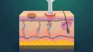 Excel V Laser Treats Bruising at Dermatology Institute of Atlanta