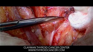 Total Thyroidectomy and Central Neck Dissection