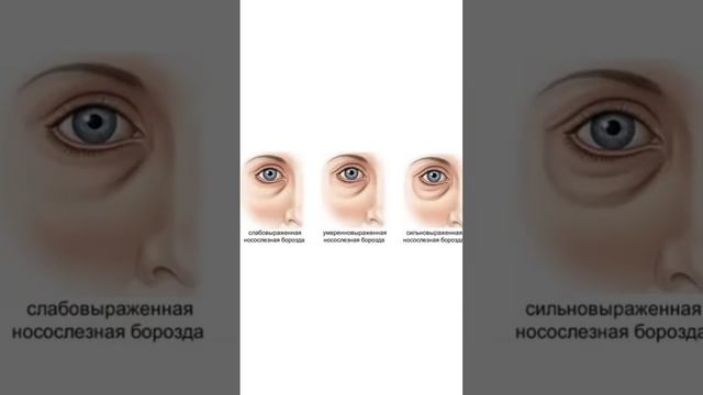 Для чего проводится липофилинг носослезных борозд?