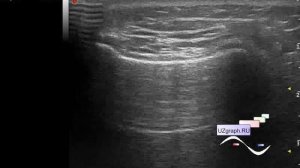 УЗИ коленных суставов - Последствия экстремальных видов спорта