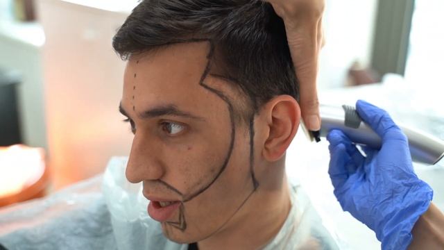 ПЕРЕСАДКА ВОЛОС В ТУРЦИИ. ПЕРЕЖИЛ НА СЕБЕ ЧТОБЫ ПОКАЗАТЬ ВАМ. смотреть онлайн