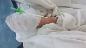 Острый задне-боковой инфаркт стентирование