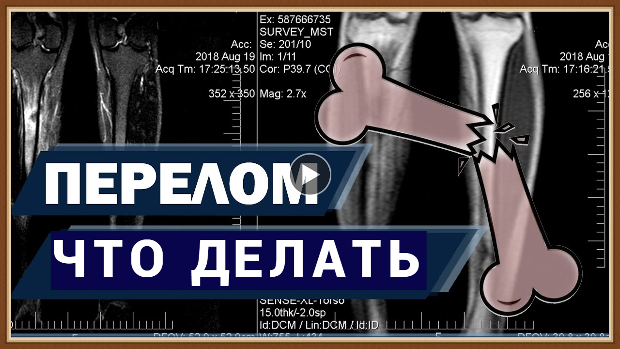 ПЕРЕЛОМ КОСТИ - ЧТО ДЕЛАТЬ