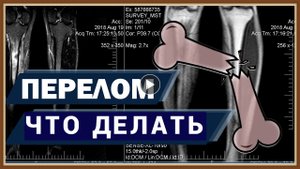 ПЕРЕЛОМ КОСТИ - ЧТО ДЕЛАТЬ