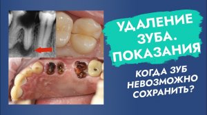Удаление зуба. Показания. Когда зуб невозможно сохранить?