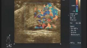 Гемангиома мягких тканей скулы на УЗИ