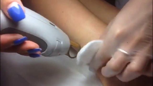Эпиляция александритовым лазером Gentle Lase GentleYag Pro-U смотреть онлайн