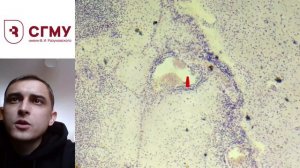 гнойный менингит