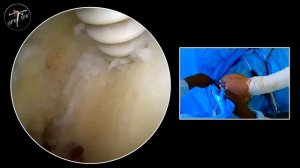 Средний разрыв вращательной манжеты, двухрядная техника с дополнительными межанкерными швами