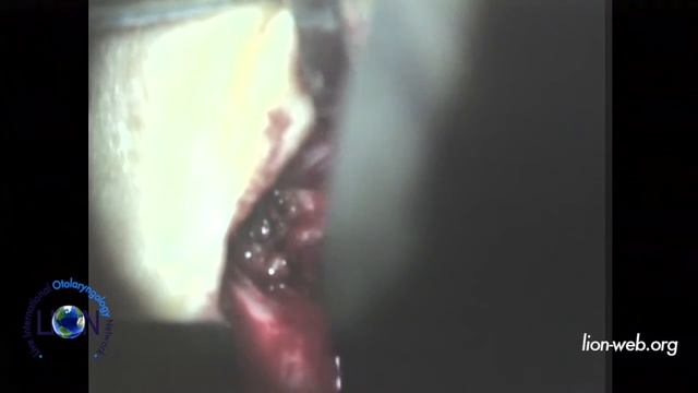 The 19th Otology Update Hannover, April 4 7 2016 Myringoplasty смотреть онлайн