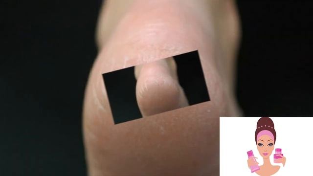 Как лечить трещины на пятках? смотреть онлайн