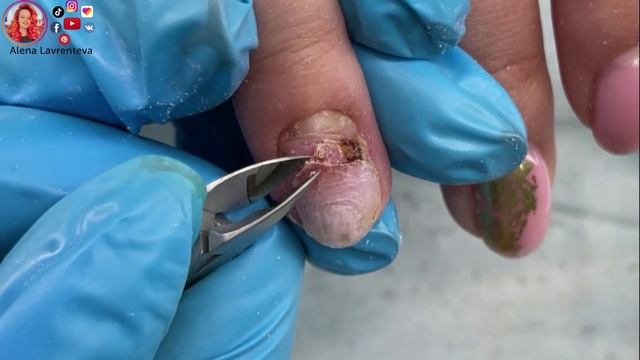 Прищемила палец дверью - ноготь вырван с корнем / 3 месяца в гипсе смотреть онлайн