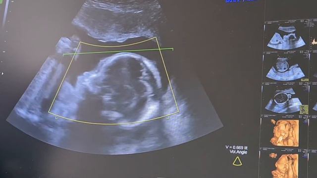 How a 3D BABY SCAN looks like - What to Expect during a 3D ULTRASOUND - 23 weeks going 24 weeks