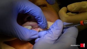 Реальная стоматология! Ретракция десны при установке керамических виниров в "Стоматологии БЕСТ"