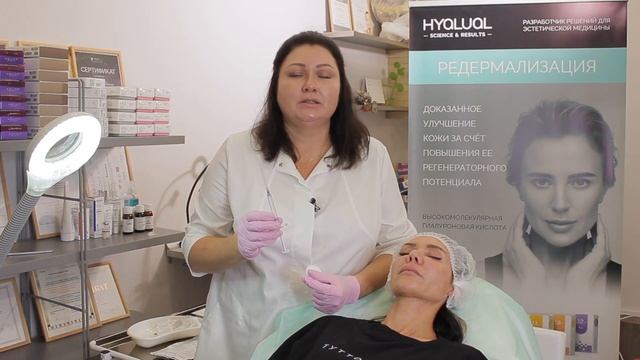 Процедура контурной пластики носа филером Радиес (Radiesse)