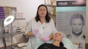 Процедура контурной пластики носа филером Радиес (Radiesse)