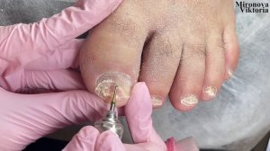 И такое бывает ? /Сложный случай… Педикюр