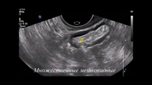 Дивертикулез сигмовидной кишки с комментариями