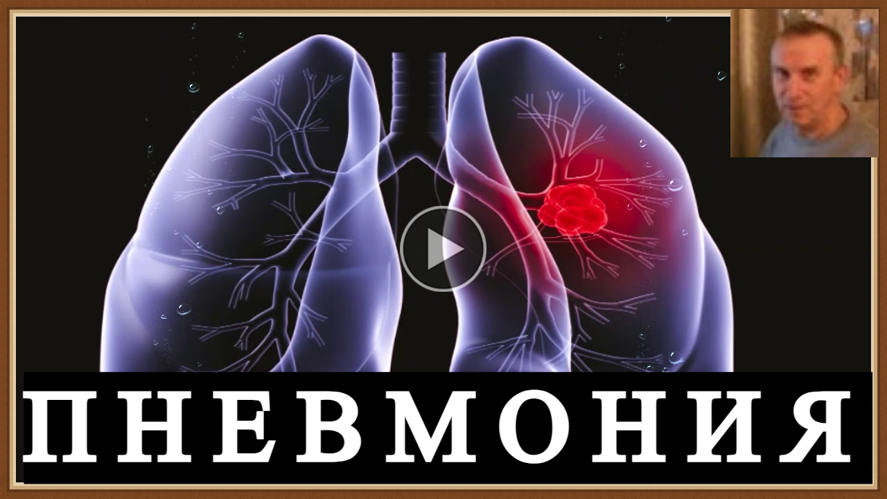 ПНЕВМОНИЯ - ВОСПАЛЕНИЕ ЛЕГКИХ
