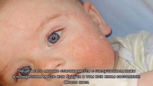 Что делать, если шелушится кожа на лице смотреть онлайн