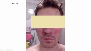 Мой опыт борьбы с себорейный дерматит на лице и перхоти 2