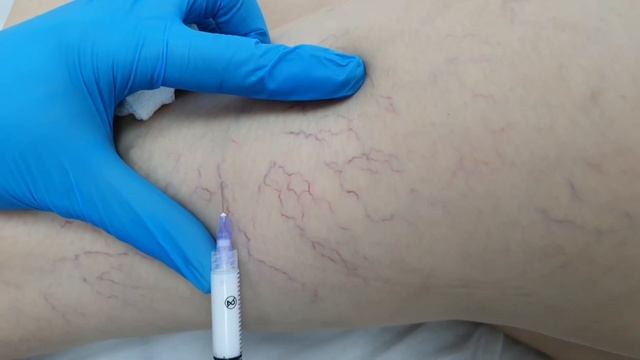 Склеротерапия сосудистых звездочек