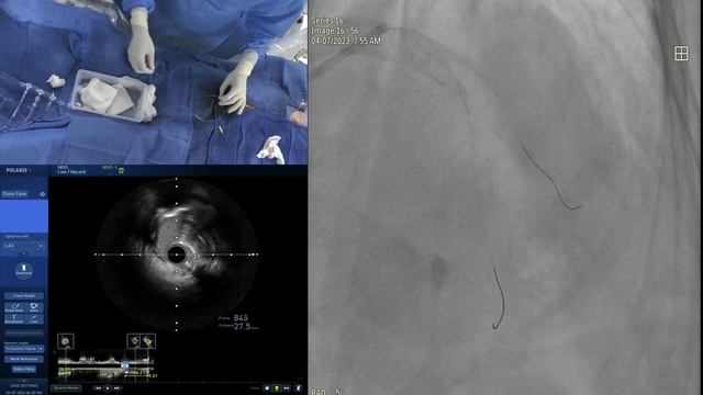 Learn From The Masters – Managing Calcified Coronaries with Rotational Atherectomy - April 2023 смотреть онлайн