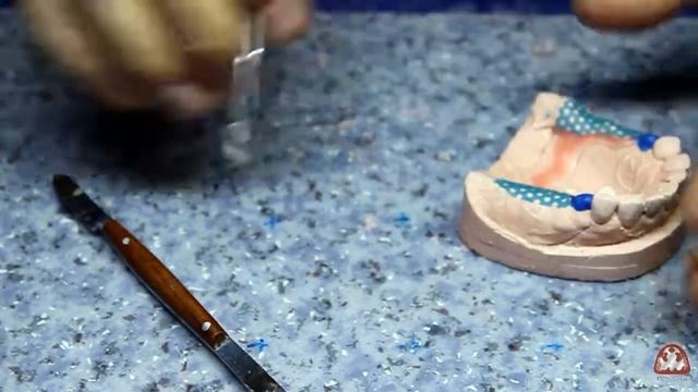 Ночное моделирование бюгельного протеза