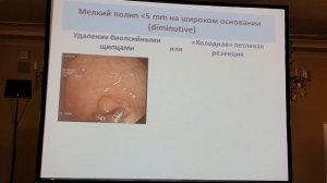 06Кашин СВ Эндоскопические методики удаления полипов толстой кишки