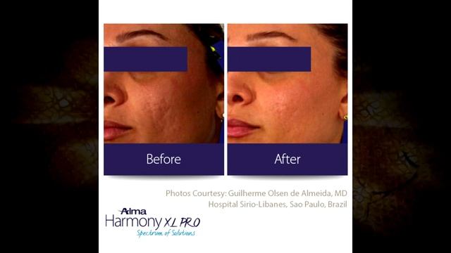 ALMA HARMONY XL PRO / LASERLAND - BIAŁYSTOK 2018 смотреть онлайн