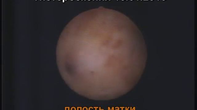 Эндометриоз тела матки. Офисная гистероскопия.