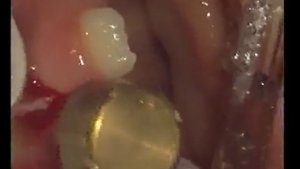 Фрэнэктомия пластика уздечки языка Erbium