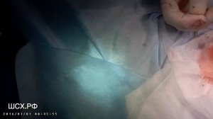 Закрытие илеостомы