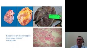 Патанатомия 8.Болезни сердечно сосудистой системы