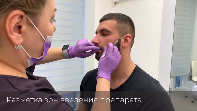 Коррекция носогубных складок