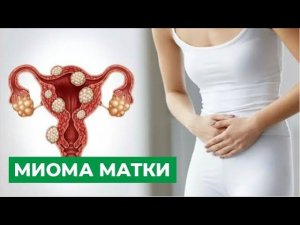 Миома матки: причины, симптомы. Лечение миомы матки.